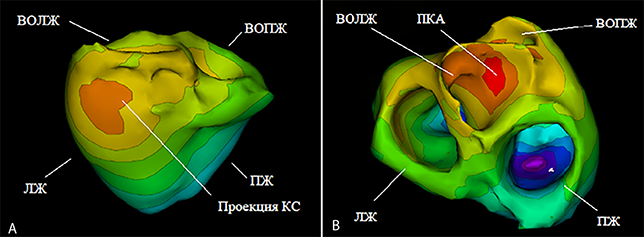 Изохронная карта по данным неинвазивной топической диагностики