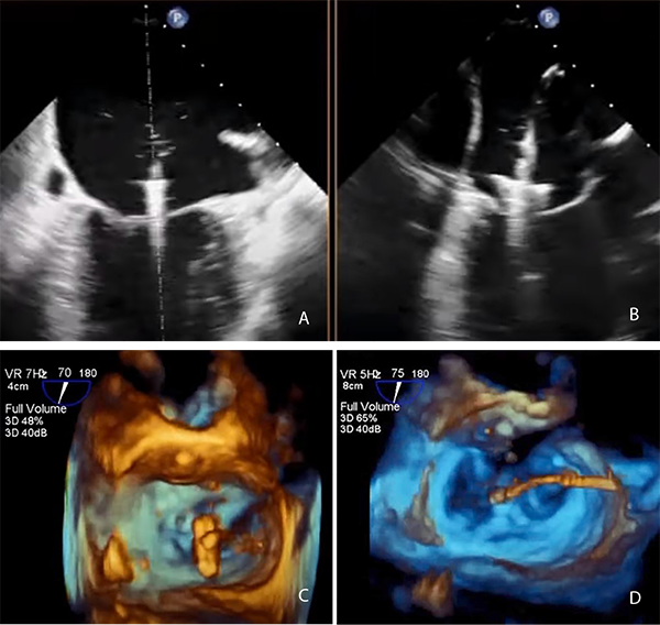 Этапы имплантации клипса в митральную позицию