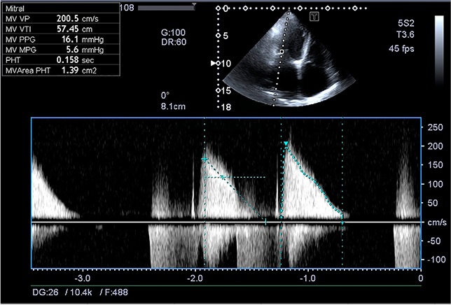Допплерография трансмитрального потока в апикальном 4-камерном сечении