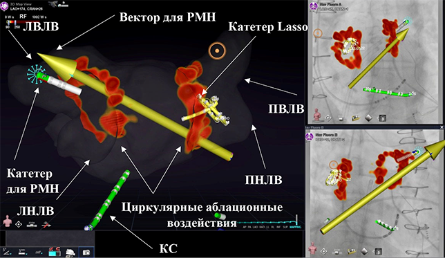 Изоляция легочных вен с помощью нефлюороскопической системы роботизированной магнитной навигации