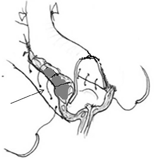 Onlay-flap анастомоз с исключением кальцината из просвета сосуда