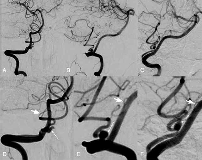 Селективная правосторонняя вертебральная ангиография