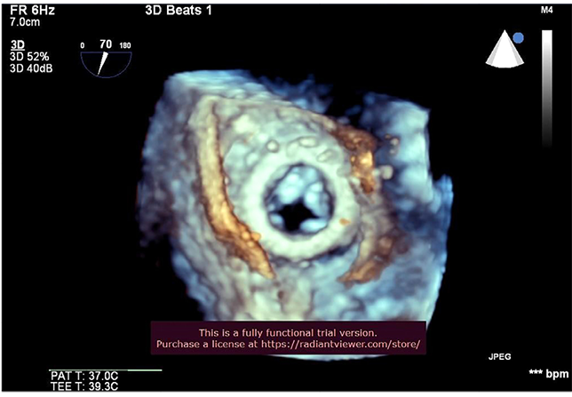 Трехмерная чреспищеводная эхокардиография до операции