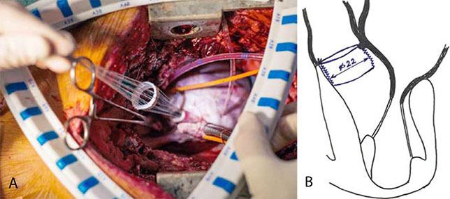 Этап укрепления аортального фиброзного кольца