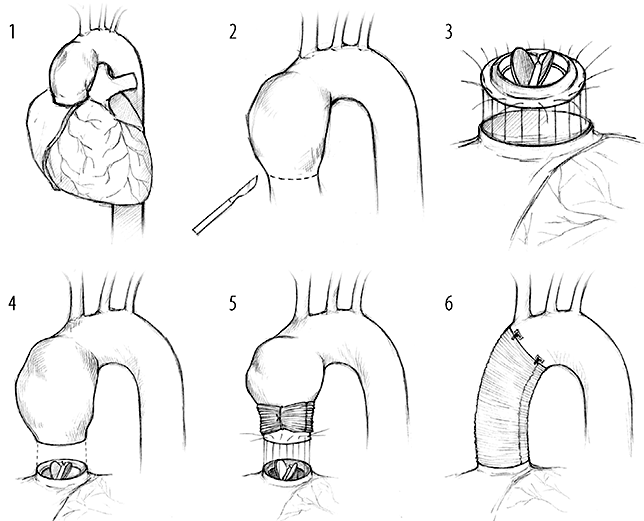 Экзопротезирование восходящего отдела аорты цельным протезом