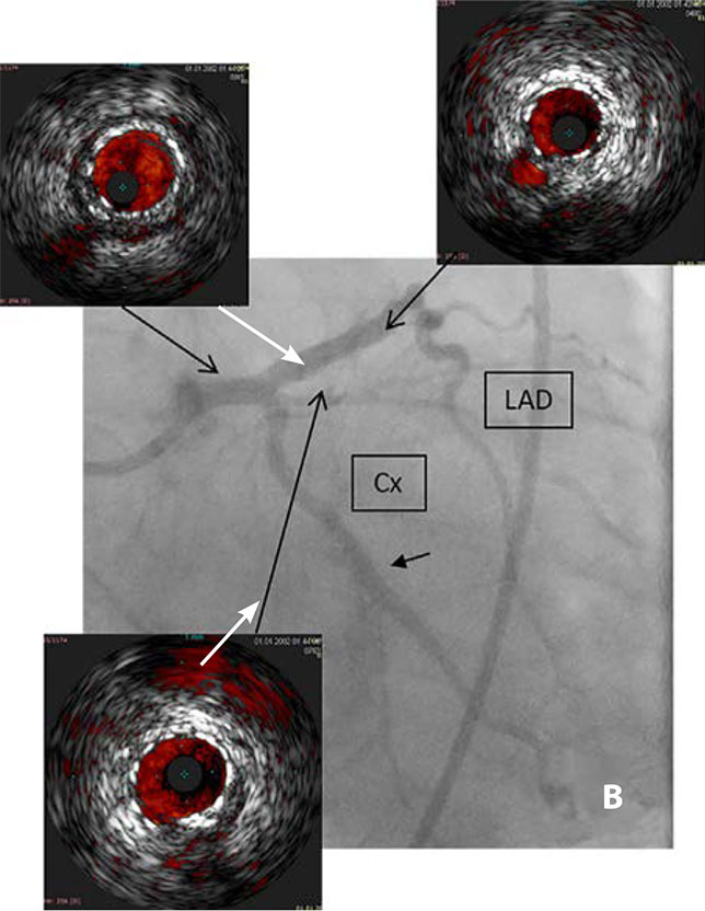 Коронарография после чрескожного коронарного вмешательства