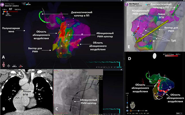 Аблация инцизионного трепетания предсердий (2 цикла) с помощью роботизированной магнитной навигации