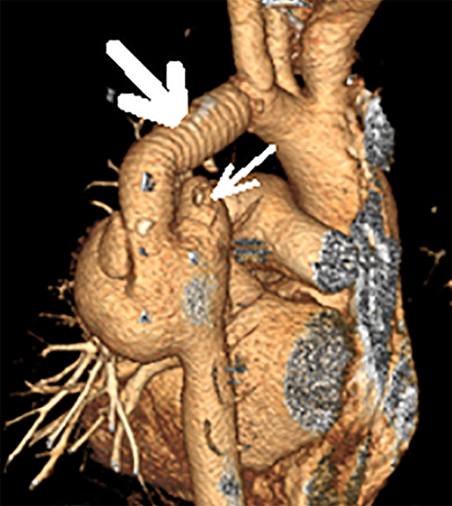Компьютерная томография органов грудной полости