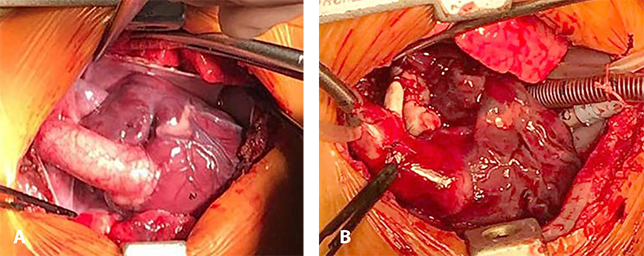 Бесшовная пластика тотального аномального дренажа легочных вен, расширяющая пластика бифуркации легочной артерии, системно-легочный анастомоз