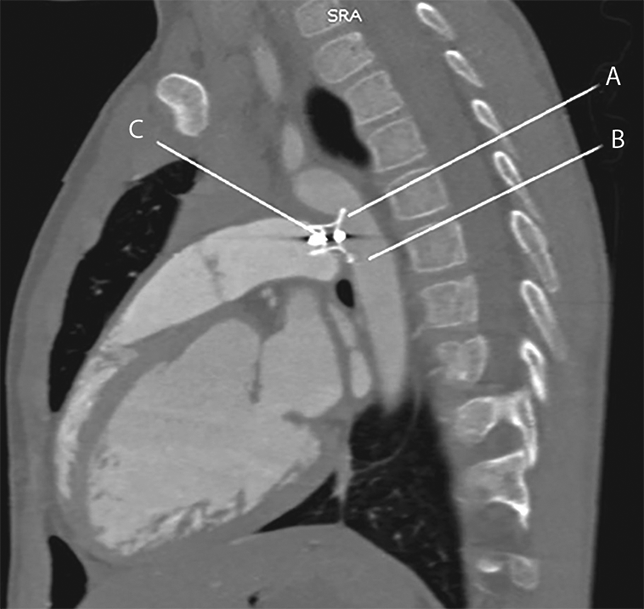 Мультиспиральная компьютерная томография сердца и аорты
