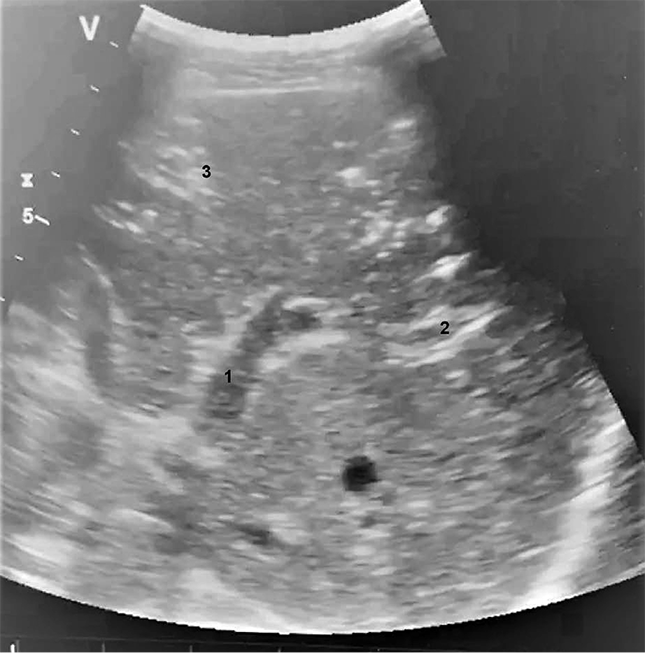 Ультразвуковая картина газа в воротной вене