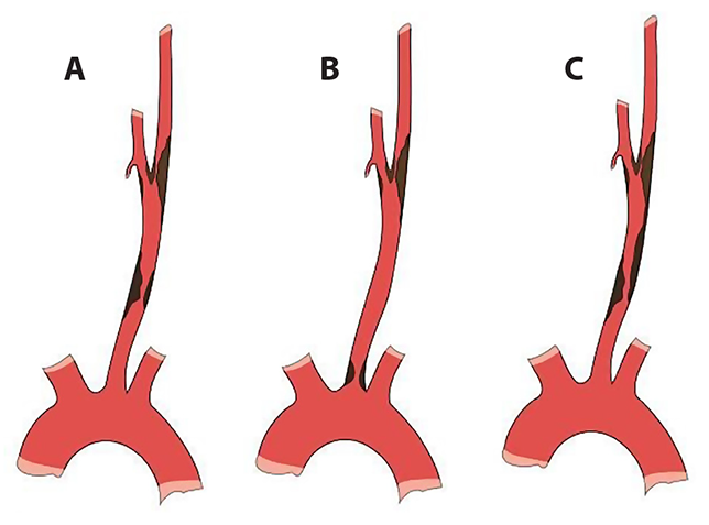 Варианты сочетаний стеноза каротидной бифуркации