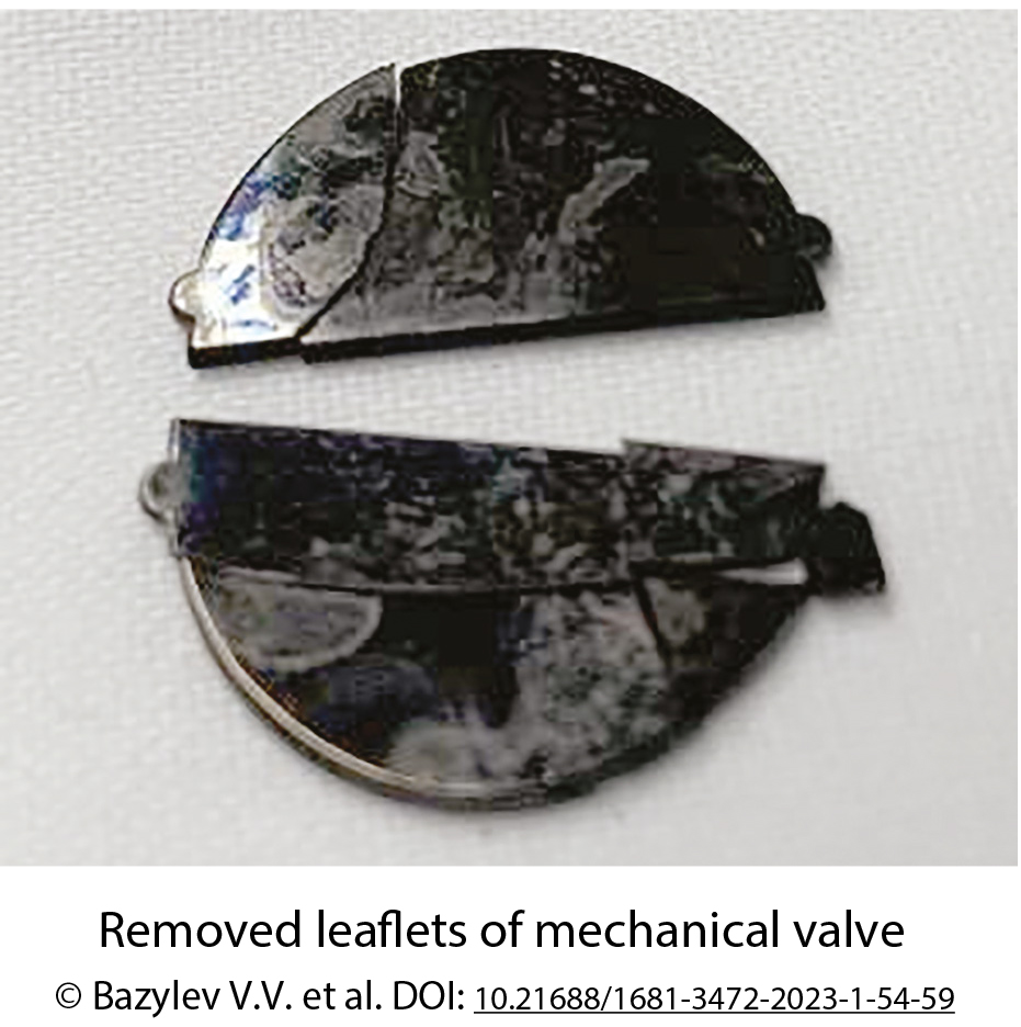 Removed leaflets of mechanical valve 