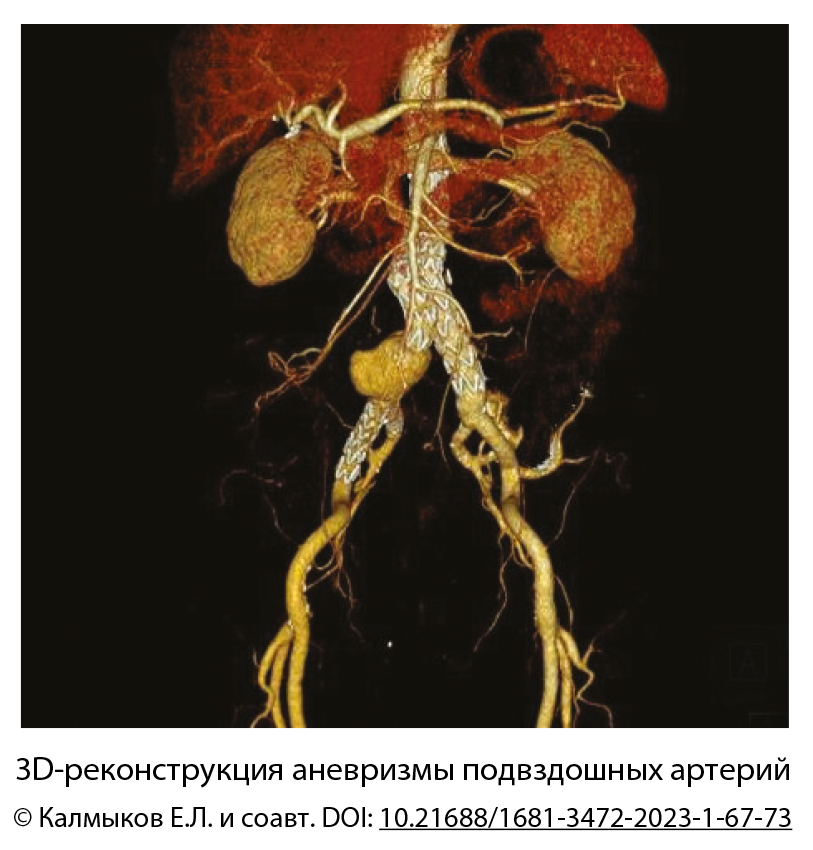 3D-реконструкция аневризмы подвздошных артерий