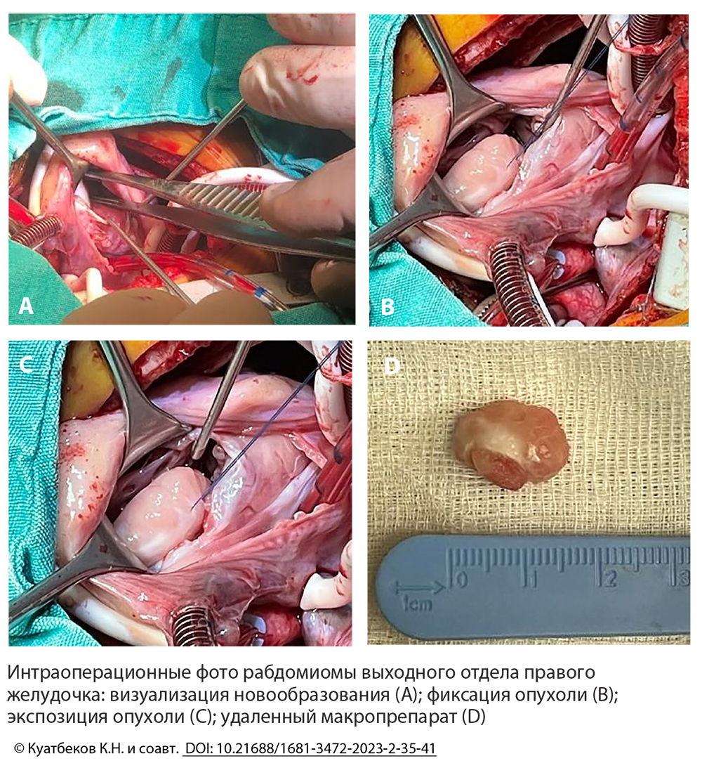 Интраоперационные фото рабдомиомы выходного отдела правого желудочка