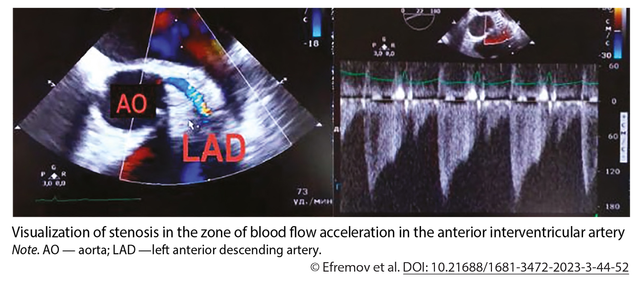 Visualization of stenosis in the zone of blood flow acceleration in the anterior interventricular artery