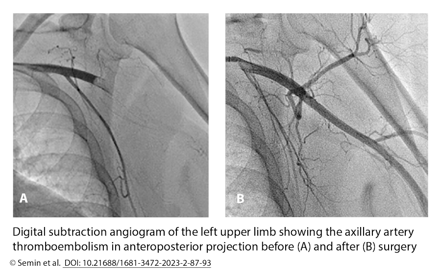 Digital subtraction angiogram of the left upper limb showing the axillary artery thromboembolism in anteroposterior projection