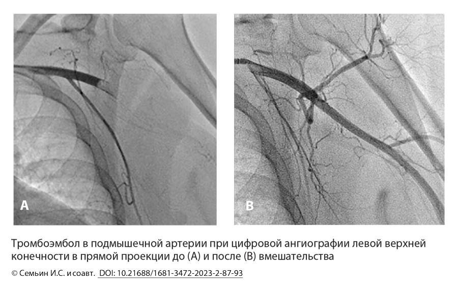 Тромбоэмбол в подмышечной артерии при цифровой ангиографии левой верхней конечности в прямой проекции
