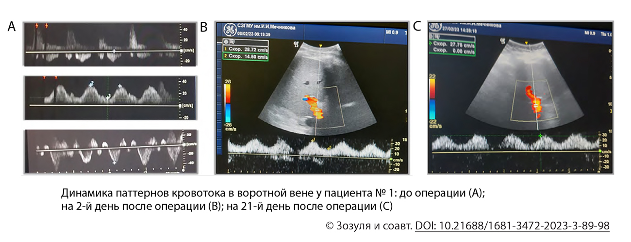Динамика паттернов кровотока в воротной вене