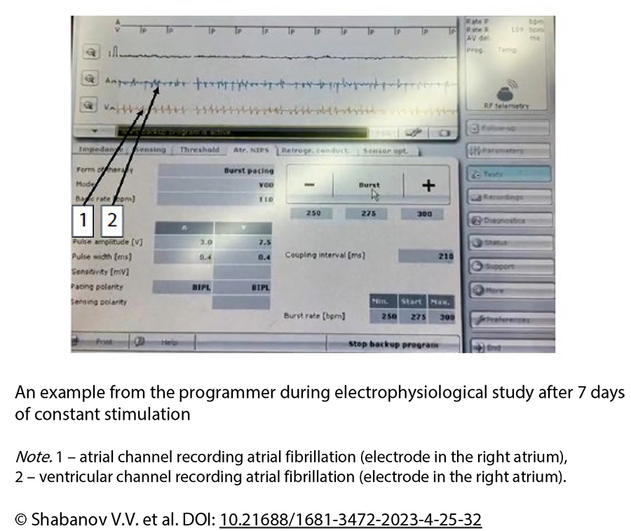 An example from the programmer during electrophysiological study after 7 days  of constant stimulation