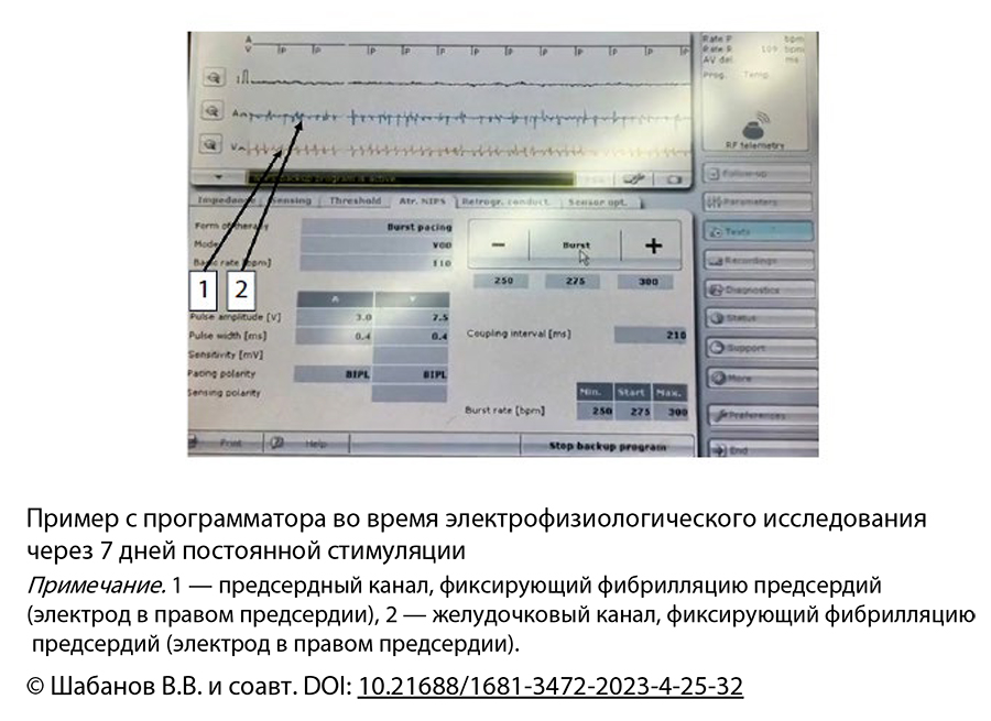Пример с программатора во время электрофизиологического исследования  через 7 дней постоянной стимуляции