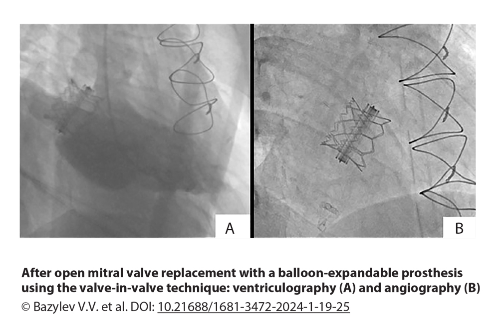 After open mitral valve replacement with a balloon-expandable prosthesis using the valve-in-valve technique: ventriculography (A) and angiography (B)