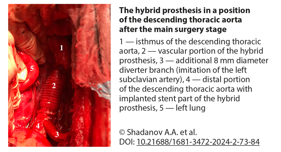 The hybrid prosthesis in a position of the descending thoracic aorta after the main surgery stage