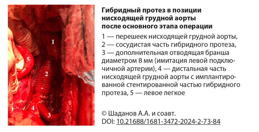 Гибридный протез в позиции нисходящей грудной аорты после основного этапа операции