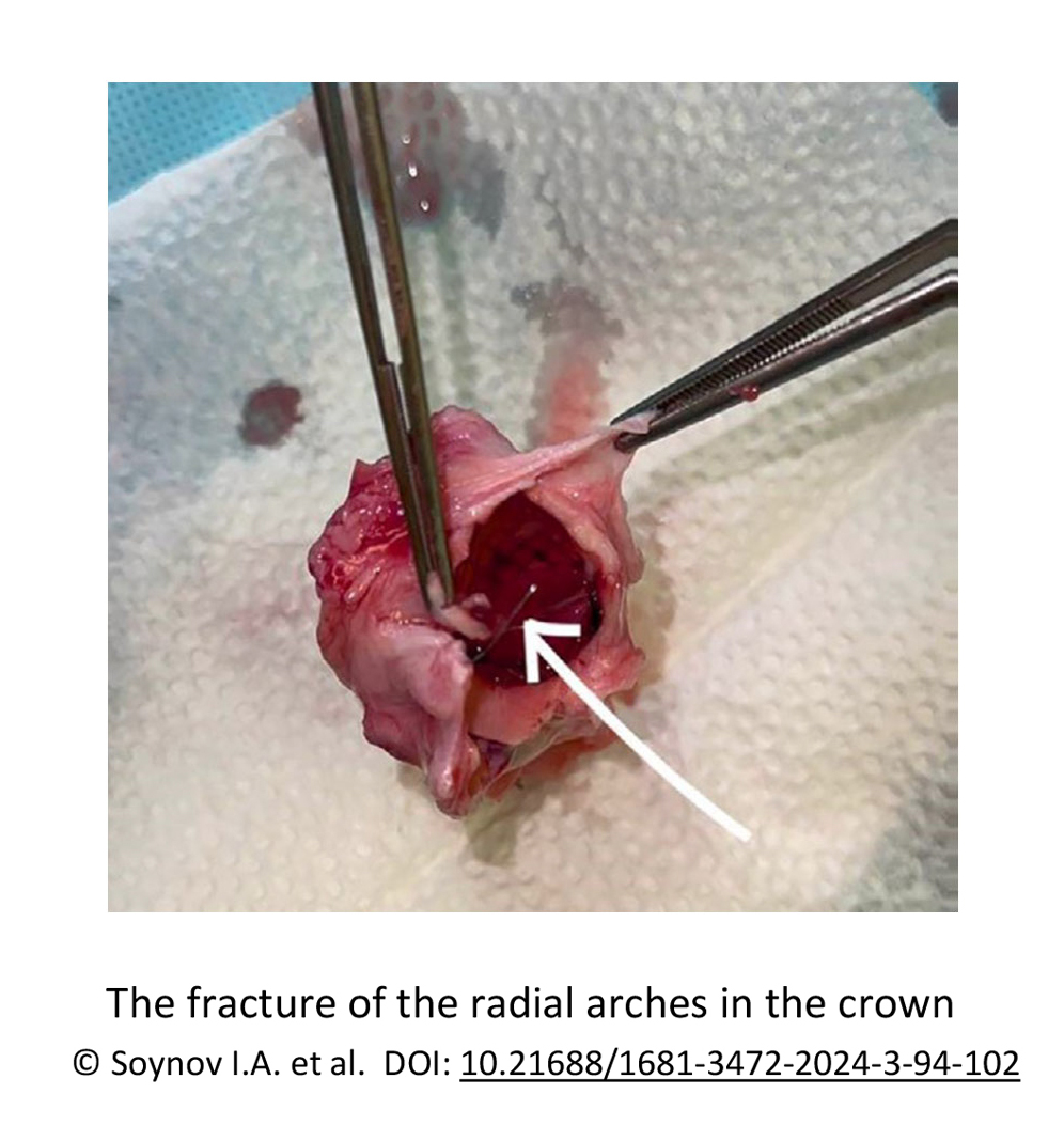 The fracture of the radial arches in the crown