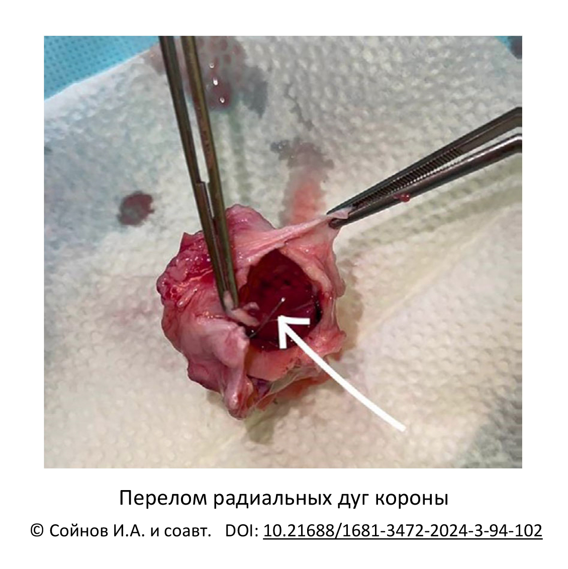 Перелом радиальных дуг короны